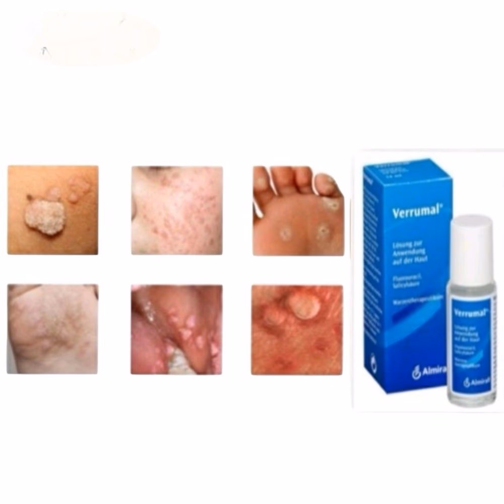 VERRUMAL Topical Solution 13ML 3