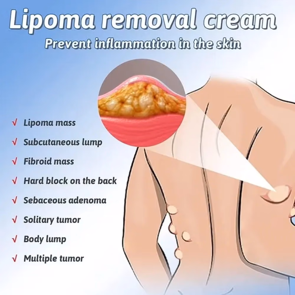 South Moon Lipoma Removal Spray 50ml 4