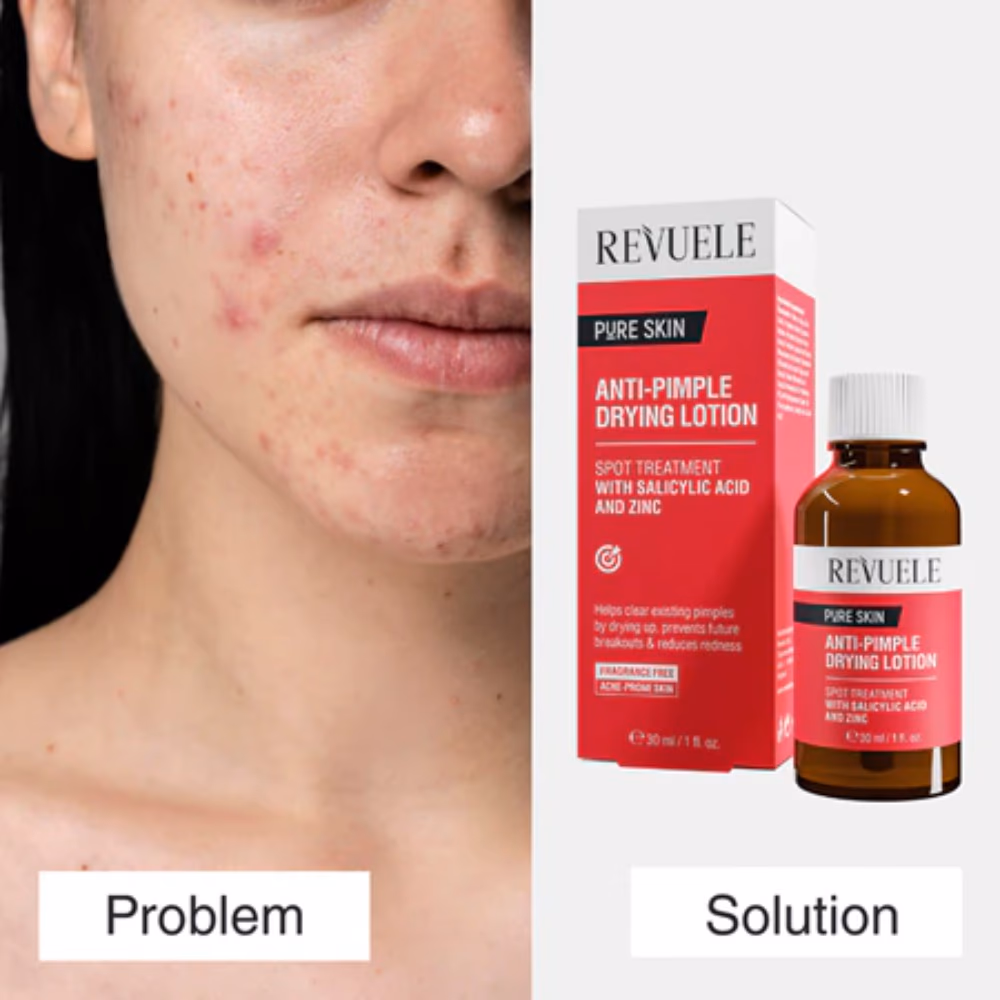 Revuele Anti Pimple Drying Lotion 30ml 2