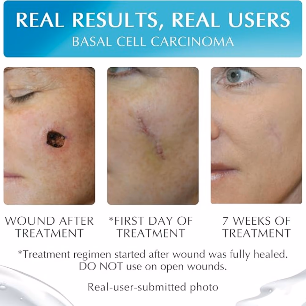 New Gel+ Silicon Gel for Scars 15gm 4