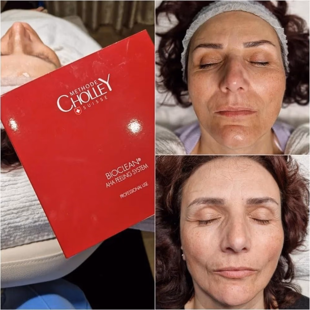 Cholley Suisse Bioclean AHA Peeling System 4