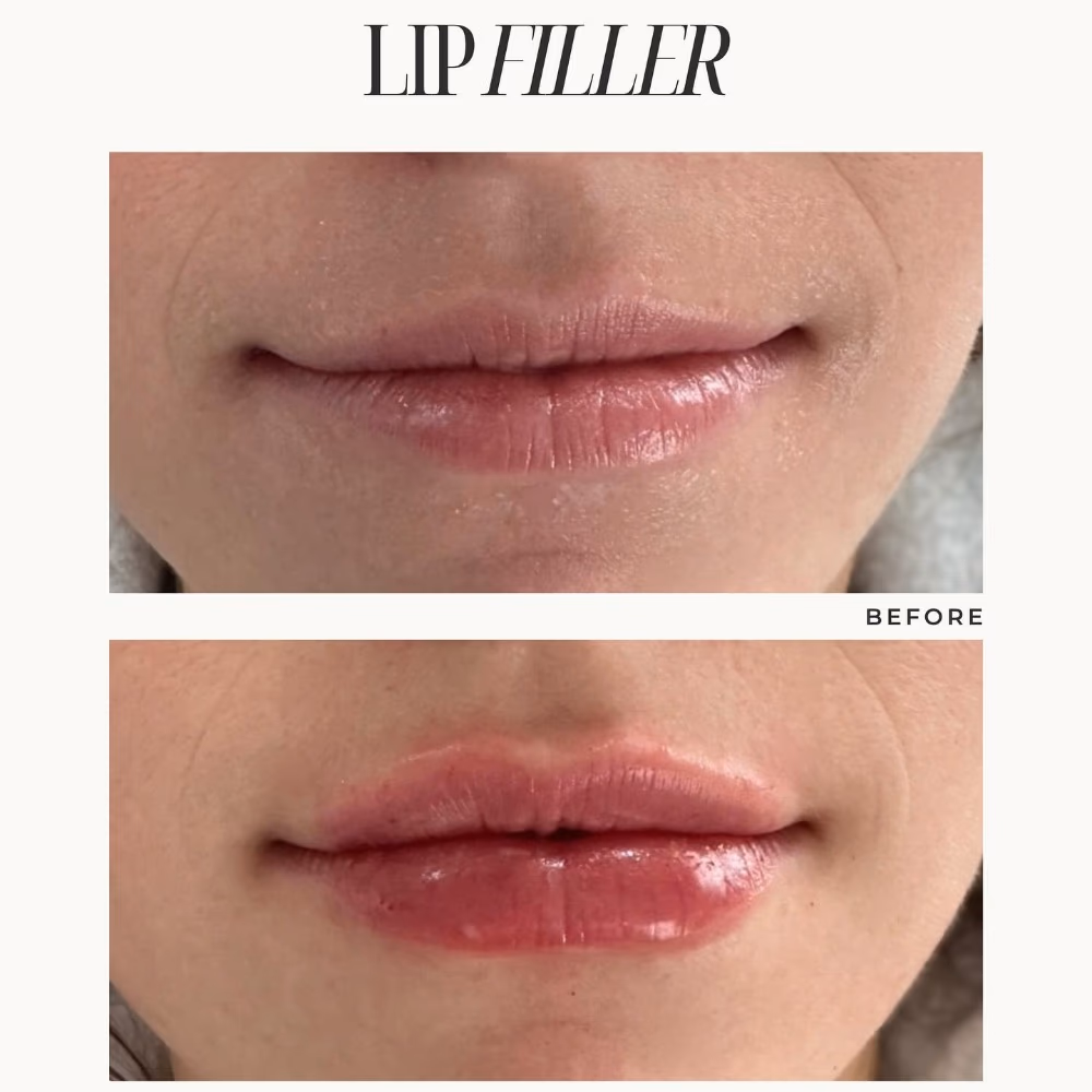 Filorga Nutri Filler Lips 4gm 5