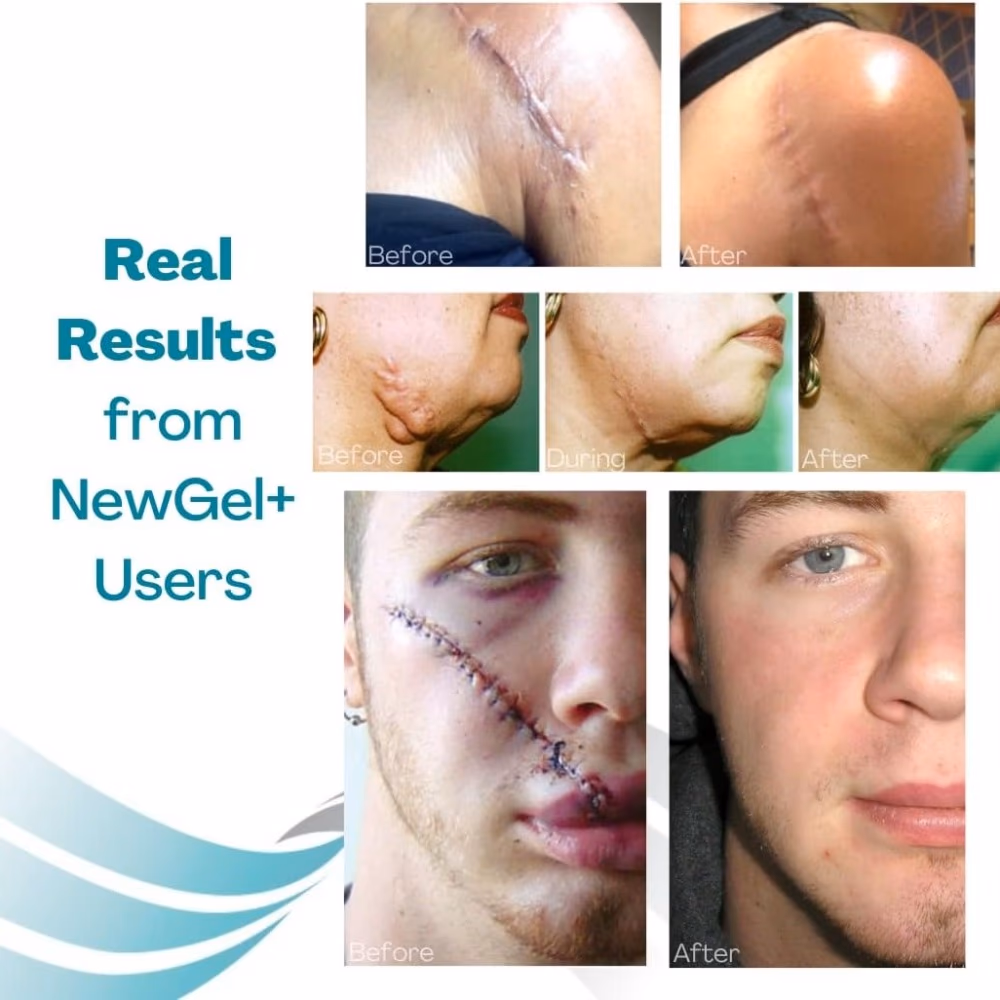 New Gel Silicon Gel Sheets for Abdomen - Beige 2