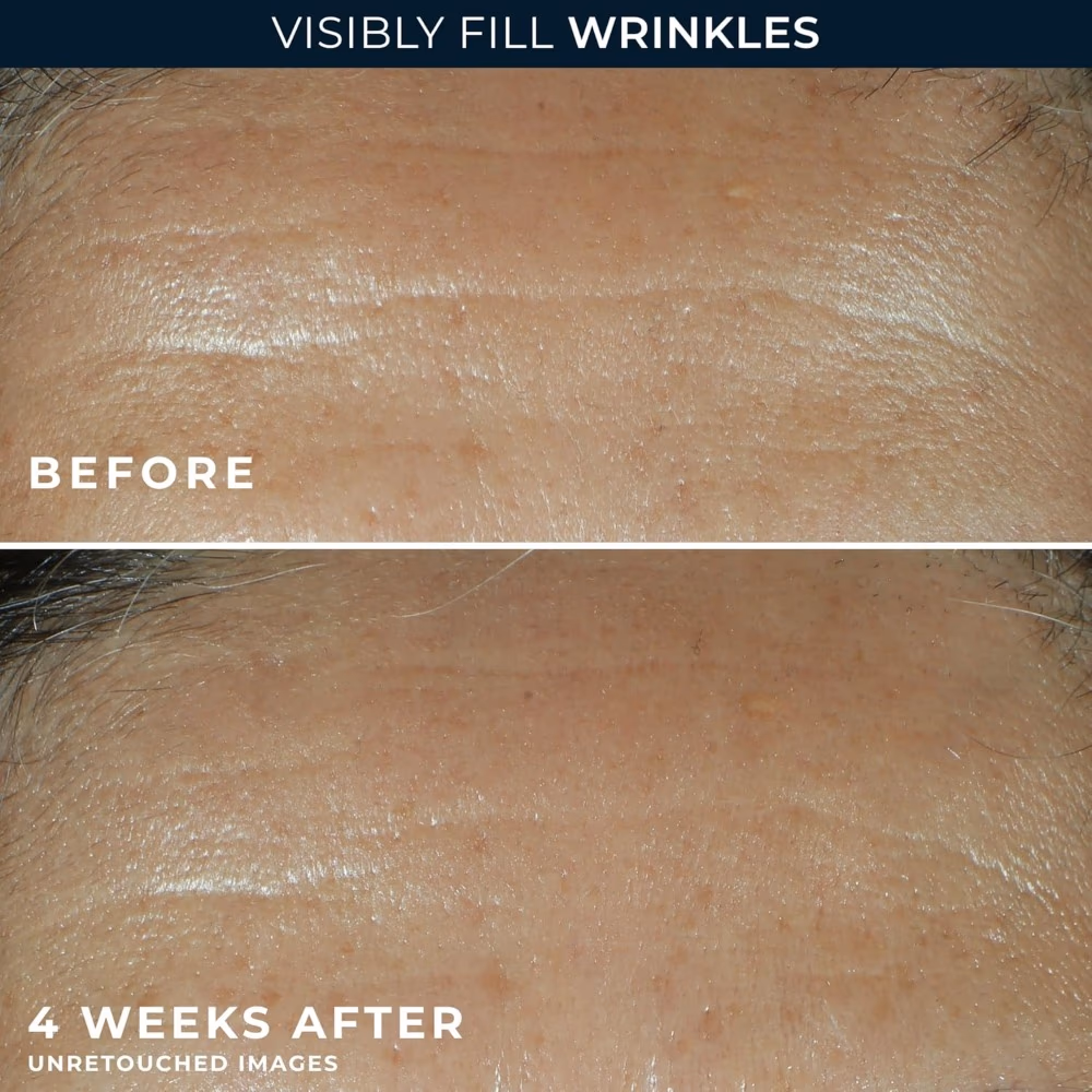 Roc Retinol Correxion Deep Wrinkle Facial Filler - 30ml 3