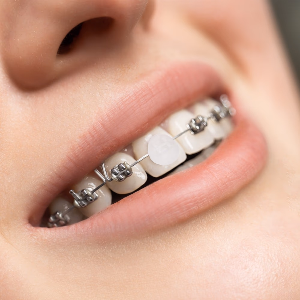 Kin Orthodontic Wax 5S for Braces and Aligners 5