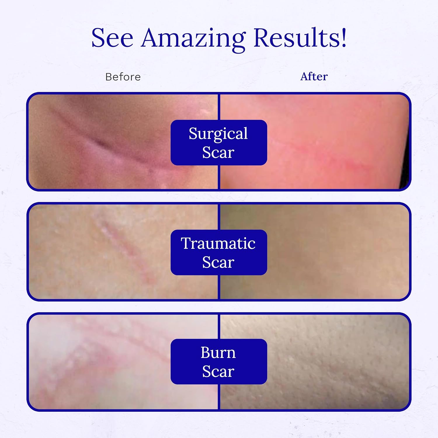 Rejuvasil Silicone Scar Gel 15ml 5